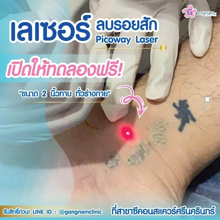 เปิดทดลองเลเซอร์ลบรอยสักฟรี