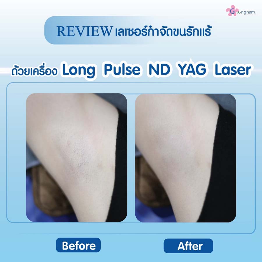 แนะนำ] เลเซอร์ขนรักแร้ ก่อนทำควรรู้อะไรบ้าง ให้ได้ผลจริงและคุ้มค่า
