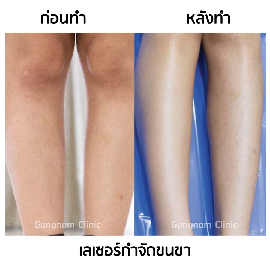 รีวิวกำจัดขนขาด้วยเลเซอร์