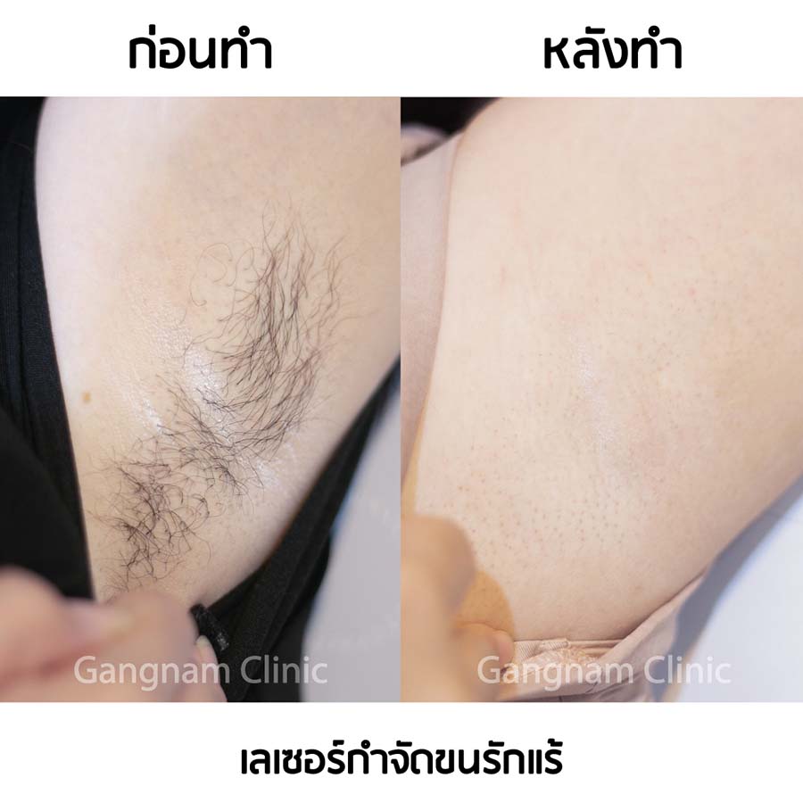 รีวิวกำจัดขนรักแร้