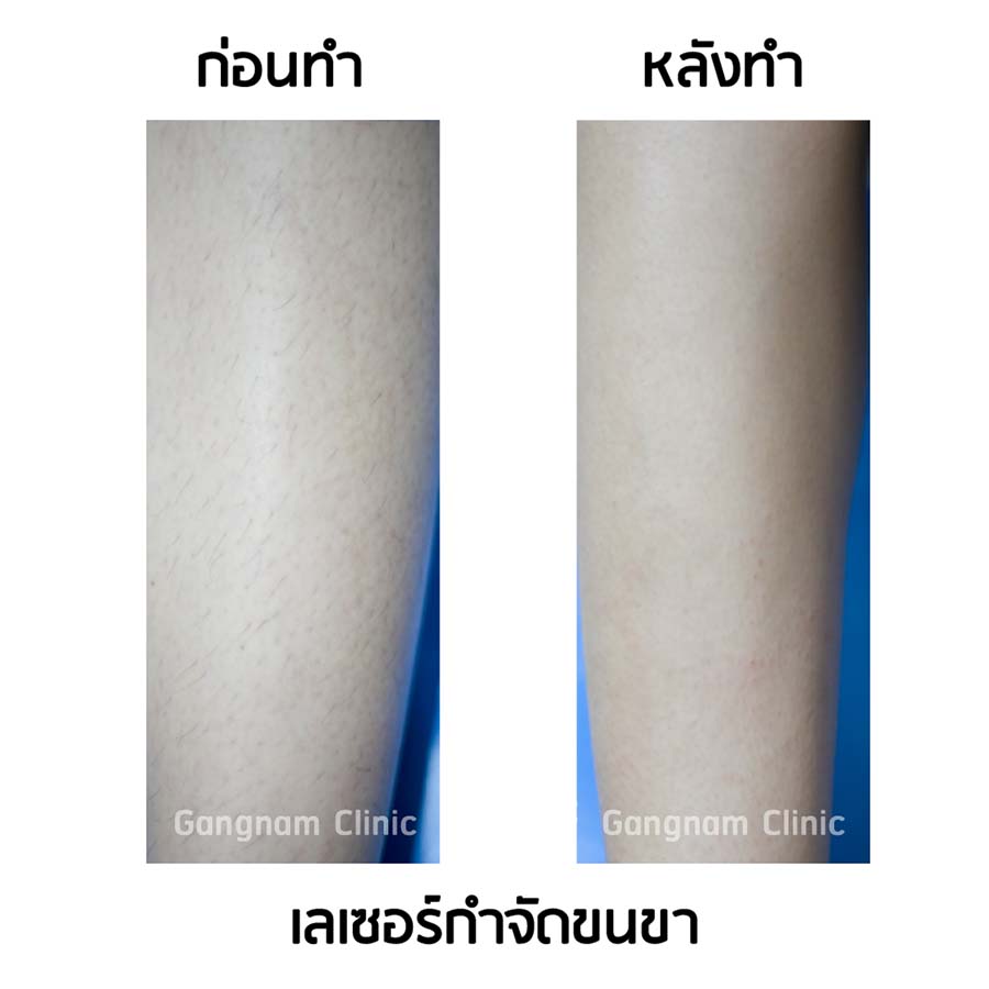 รีวิวเลเซอร์กำจัดขนขา