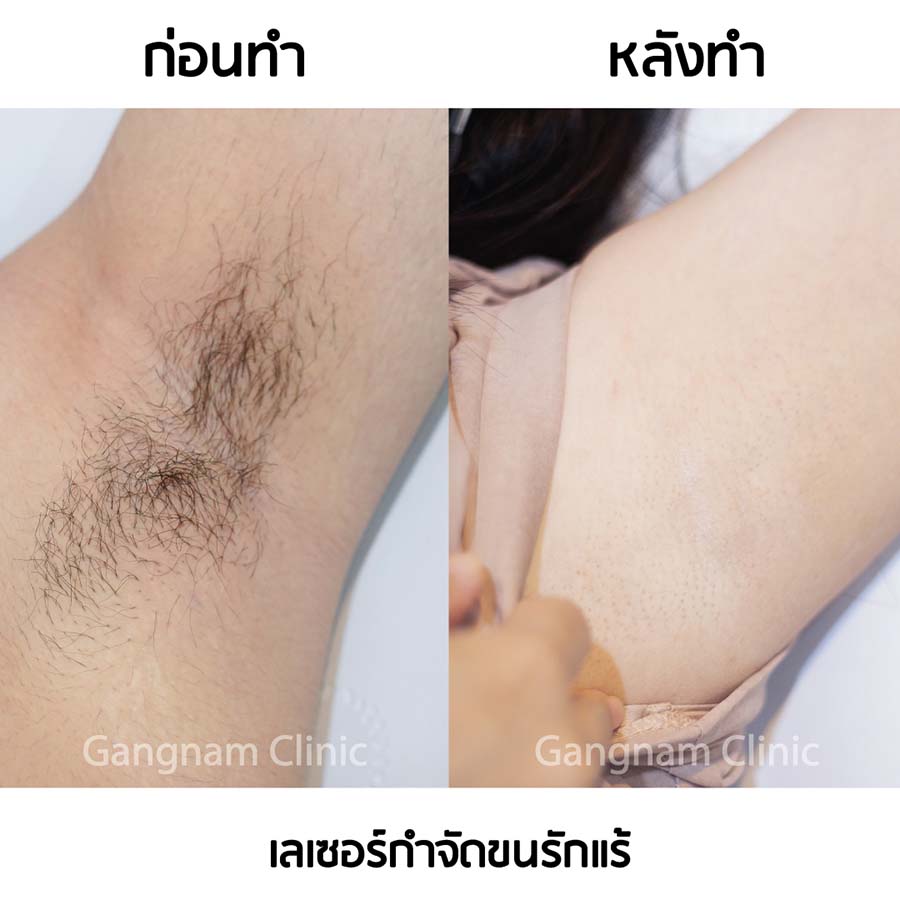 รีวิวเลเซอร์กำจัดขนรักแร้