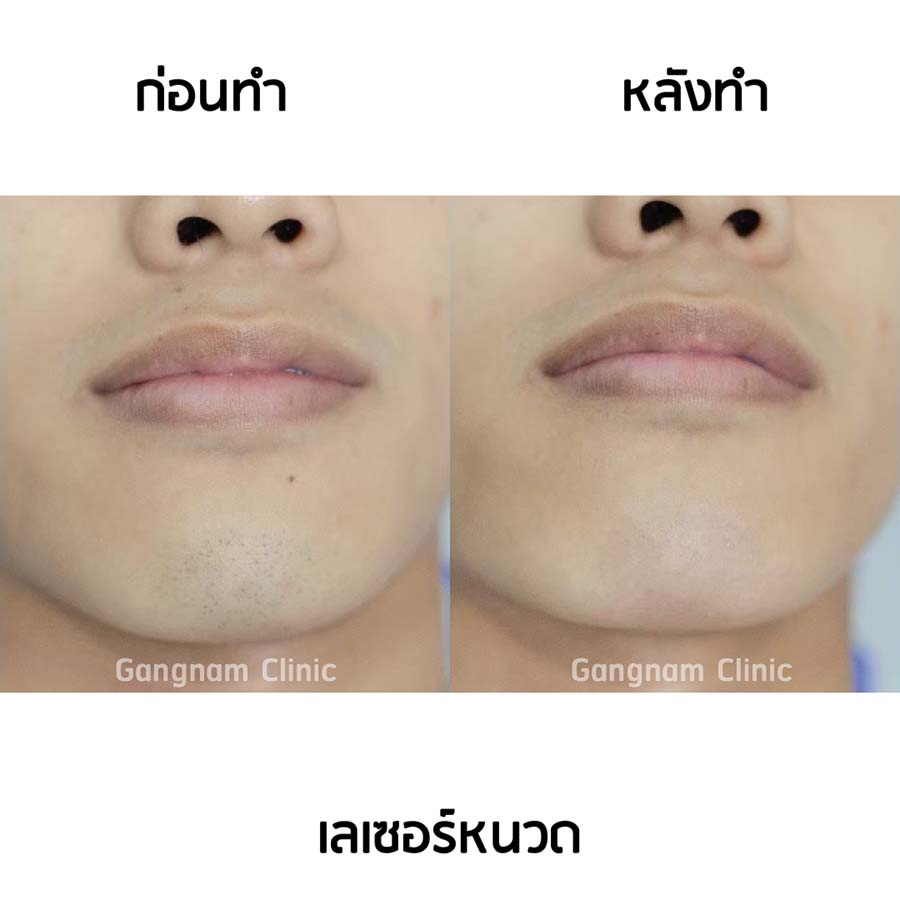 รีวิวเลเซอร์กำจัดหนวด