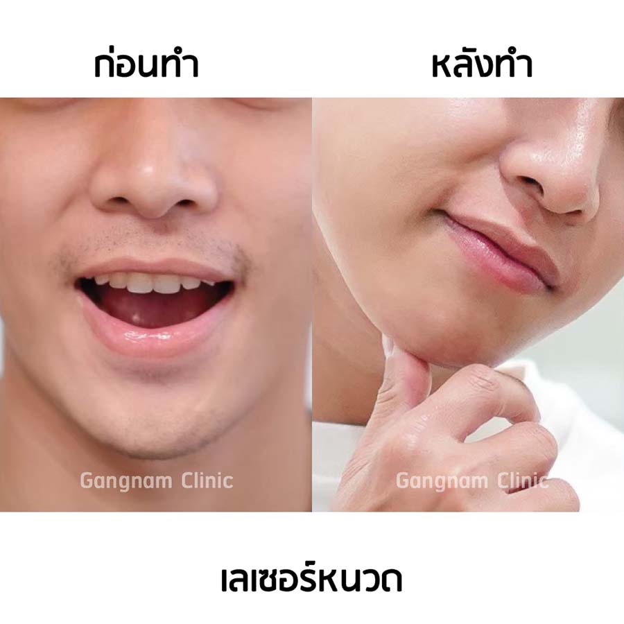 รีวิวเลเซอร์หนวด ผู้ชาย