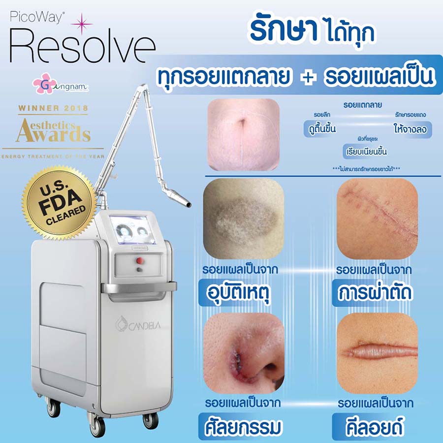 Picoway Laser รักษารอยแตกลาย