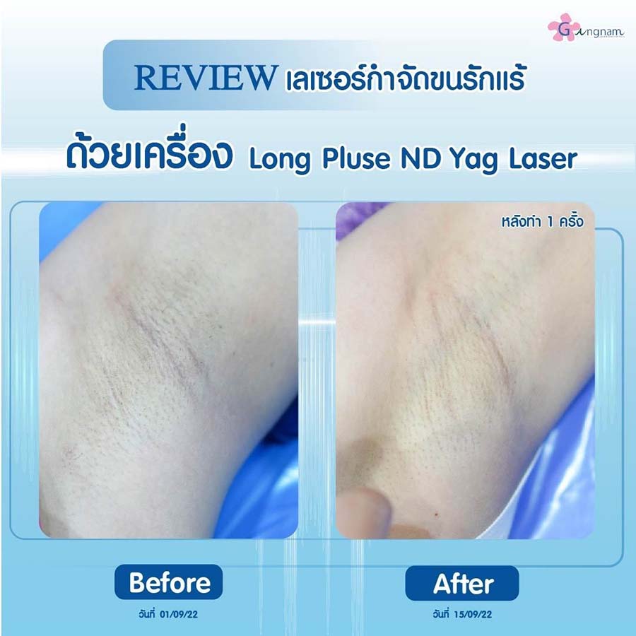 แนะนำ] เลเซอร์ขนรักแร้ ก่อนทำควรรู้อะไรบ้าง ให้ได้ผลจริงและคุ้มค่า
