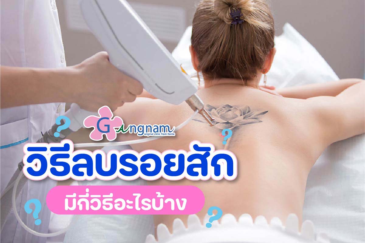 10 วิธีลบรอยสัก แบบธรรมชาติ ที่ทำแล้วไม่เป็นแผลเป็น ได้ผลจริงปี 2023