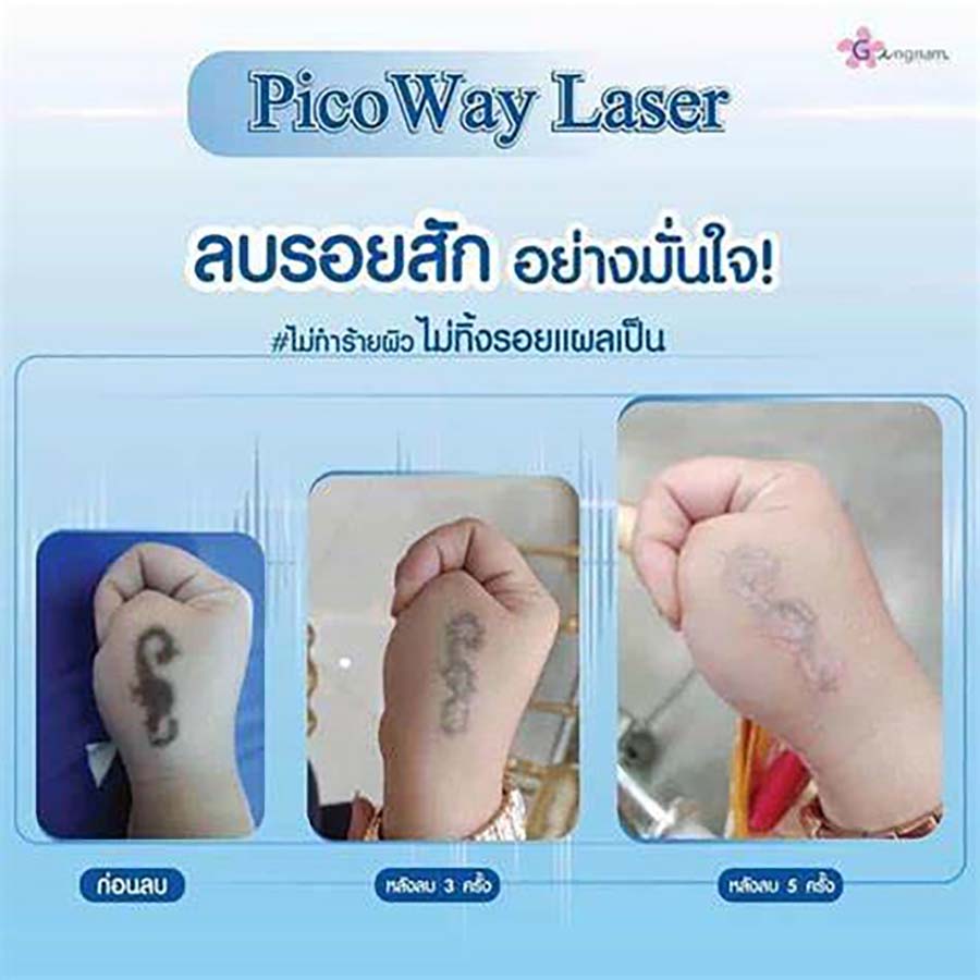 วิธีลบรอยสัก ด้วย picoway ที่ข้อมือ