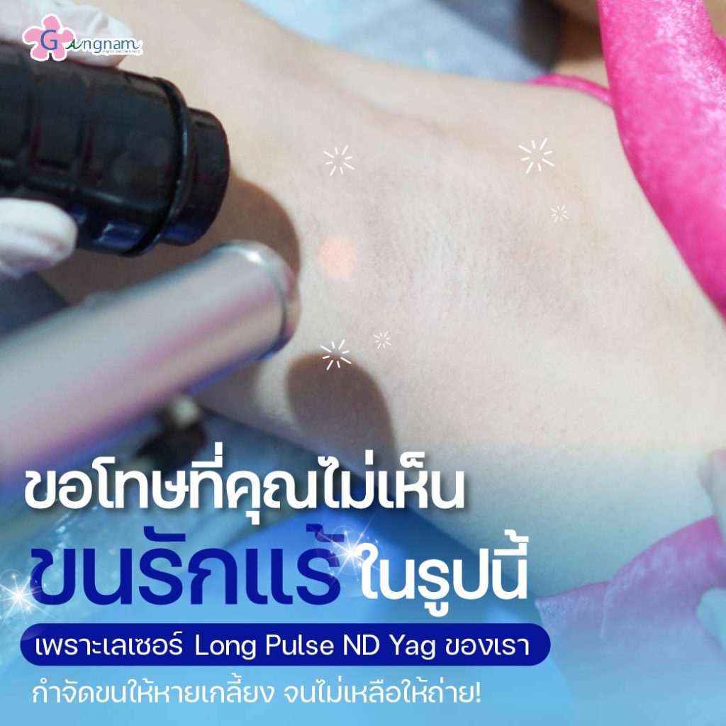 Long Pulse ND Yag ช่วยเรื่องอะไร