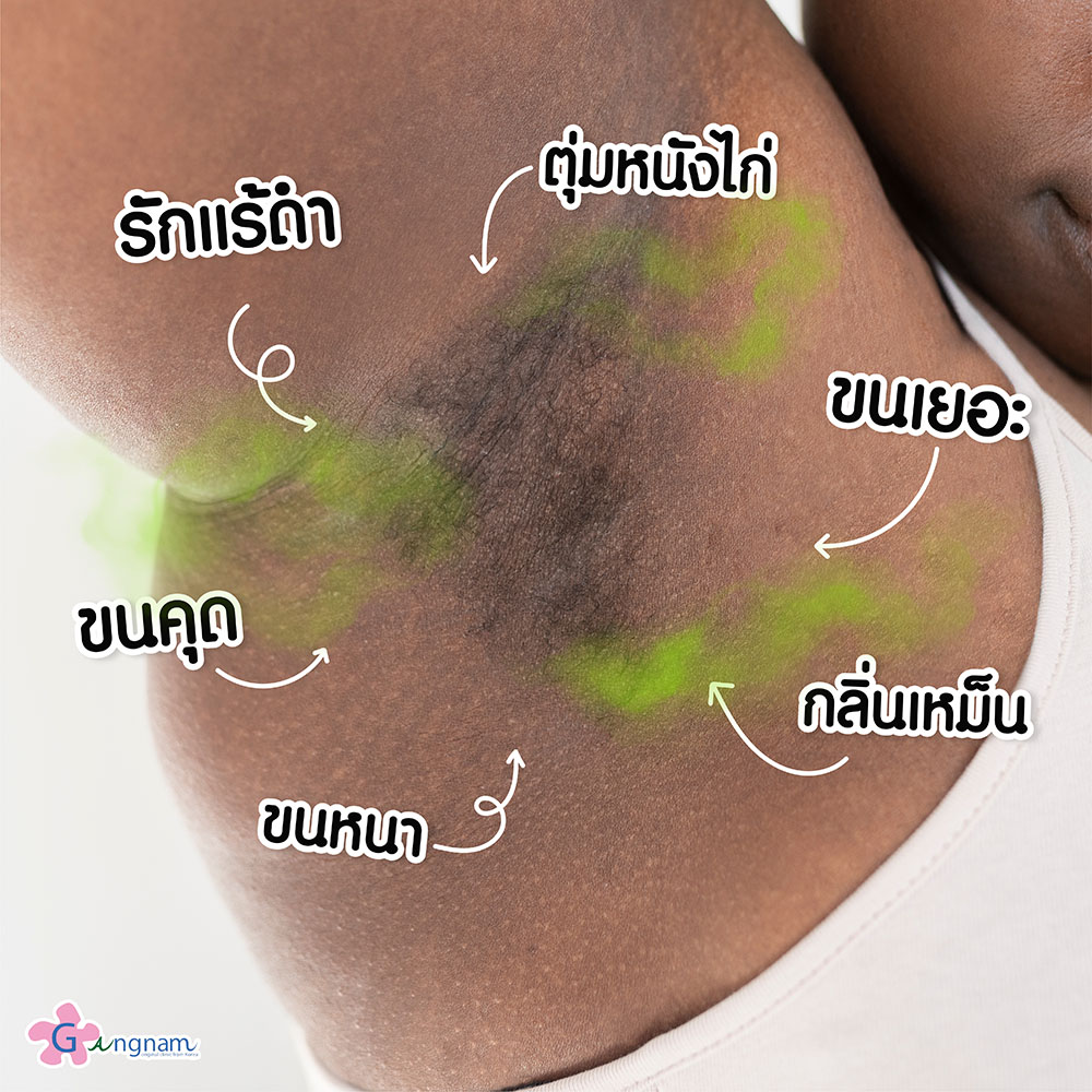 รักแร้ดำ ผิวใต้วงแขนคล้ำ เกิดจากอะไร