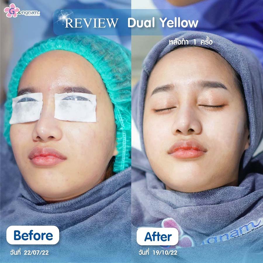 รีวิวหลังทำ dual yellow laser